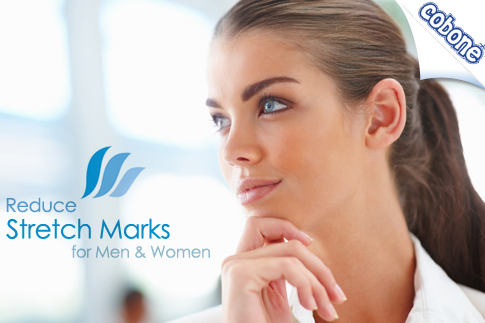 Laser Treatment for Stretch Marks
