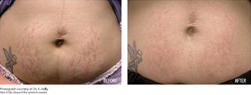 acido glicolico smagliature prima e dopo acido glicolico smagliature prima e dopo