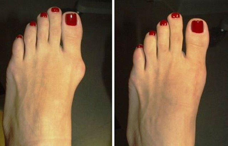 ClioMakeUp-Vesciche-ai-Piedi (4)