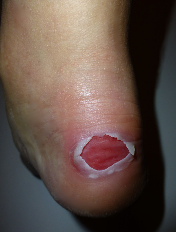 ClioMakeUp-Vesciche-ai-Piedi (5)