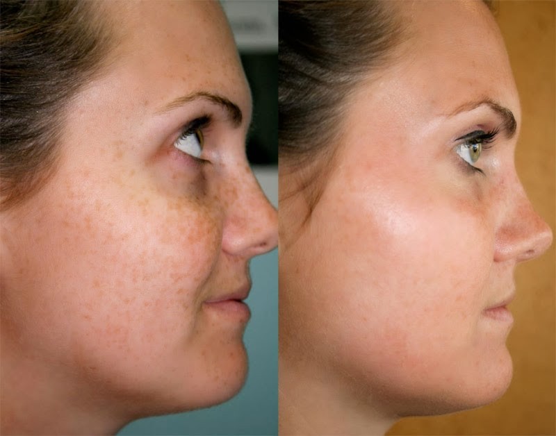 ClioMakeUp-post-gravidanza-belle-macchie-maschera-gravidica