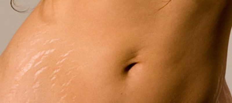 ClioMakeUp-post-gravidanza-belle-macchie-maschera-smagliature