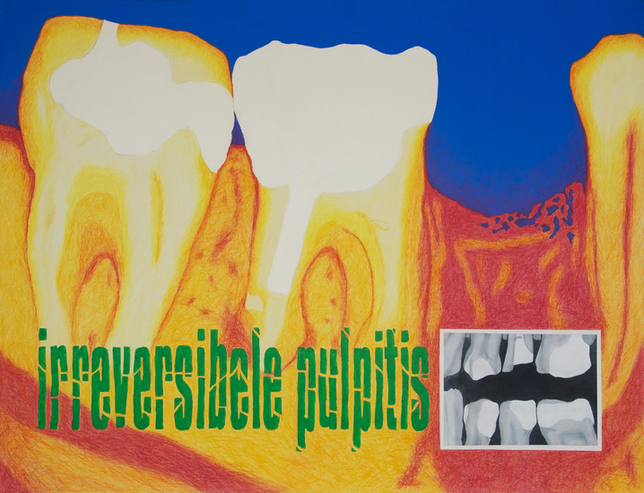 Look (at) inside me; Irreversibele Pulpitis