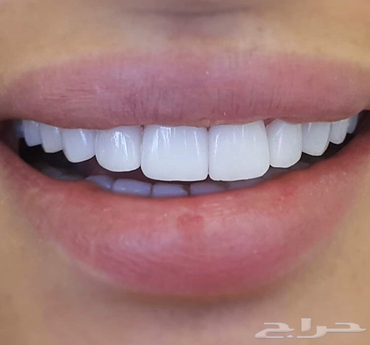 ابتسامة هوليود الثابتة