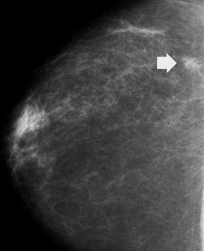 Breast cancer by nanab96 Infogram