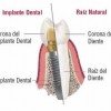 Implantes y tipos de prótesis | Blog de Masquemedicos