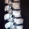 Fractura vertebral - Segundo Carlos Llumiguano Zaruma