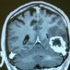 Tumor cerebral pre operacion - Segundo Carlos Llumiguano Zaruma