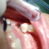 Después del implante - Implantes dentales