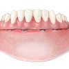 Dentadura hibrida sobre implantes - Implantes dentales