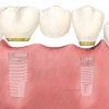 Puente sobre implantes - Implantes dentales