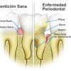 Periodoncia - AB Santa Coloma Clínica Dental