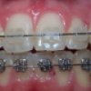 Ortodoncia - AB Santa Coloma Clínica Dental