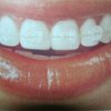 Ortodoncia - AB Santa Coloma Clínica Dental