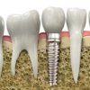 Implantes dentales - Dr. Eduardo González Cardero