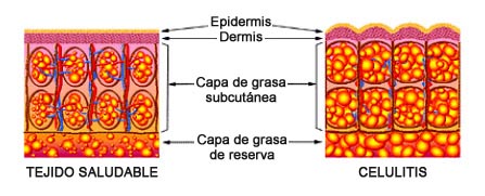 Evolución celulitis