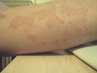 Alergia