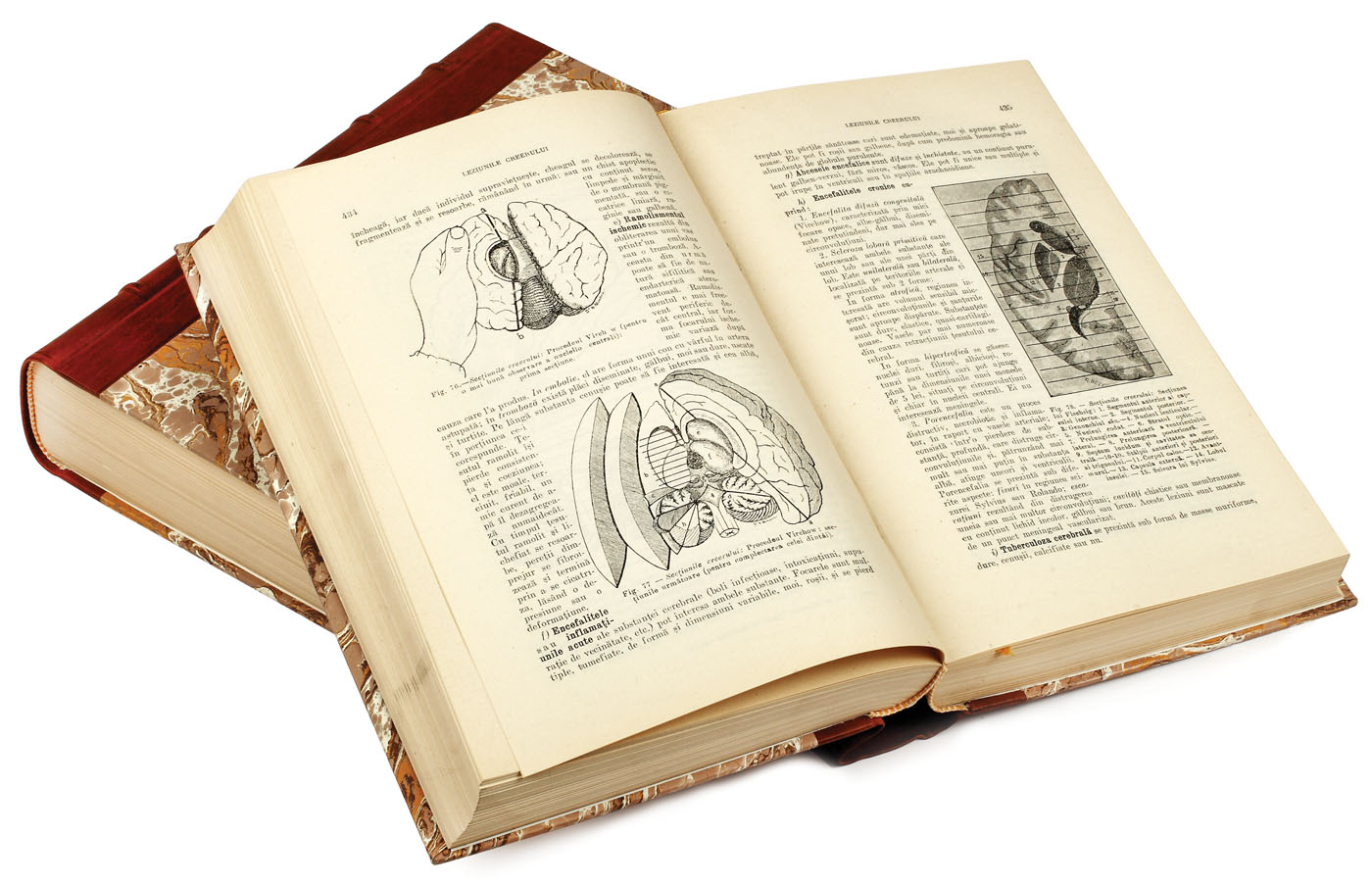 "Tratat complect de Medicină legală cu legislația și jurisprudența românească și streină" de Profesor Dr. Mina Minovici, două volume, București, 1928