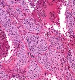 http://www.microscopyu.com/staticgallery/pathology/images/epidermoidcarcinoma10x02.jpg