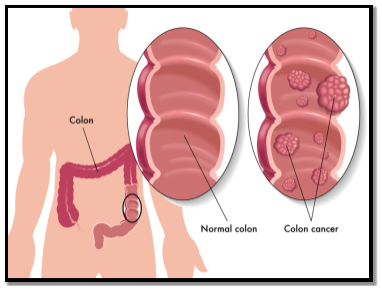 Differences between normal and cancerous colon