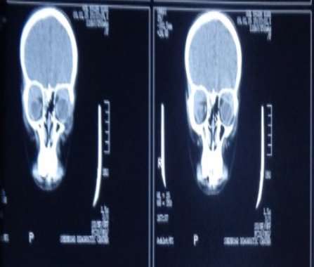 E:\PRESENTATION\GUL FAIDA ROSAI DORFMAN SYNDRUM\CT ORBIT\DSC00187.JPG