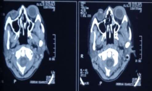E:\PRESENTATION\GUL FAIDA ROSAI DORFMAN SYNDRUM\CT ORBIT\DSC00186.JPG