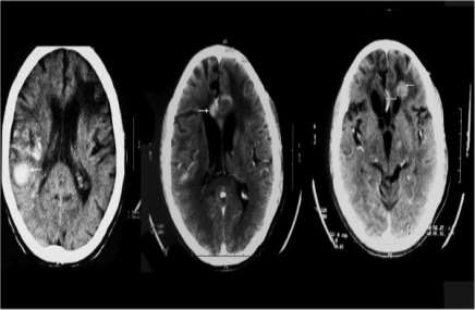 hemoragii cerebrale multiple