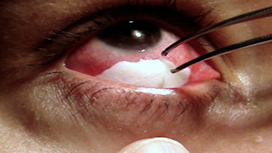 Crying Crystals: White Discs Rise From Nursery Worker's Eyes