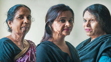 Make Love Not Scars: Acid Attack Survivors Get A Second Chance