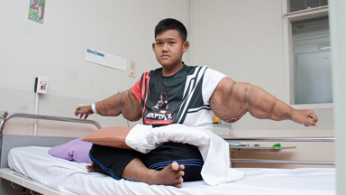 'World’s Heaviest Kid' Has Saggy Skin Surgery