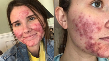 Sharing My Severe Acne Journey