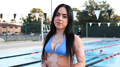 My Vitiligo Stopped Me Wearing Bikinis - Until Now