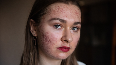 I'm Finally Happy To Show My Acne On Instagram