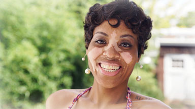 Black and White Skin: Body Positive Mom Owns Her Vitiligo Condition