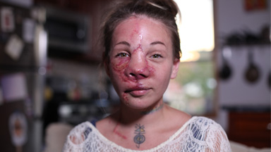Surgeons Create Mum's New Face