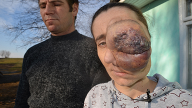 Mum with tumour covering her face is hoping for lifechanging surgery