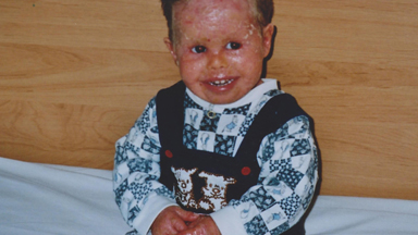 Teenager's Rare Skin Condition is Relieved by Fish Therapy