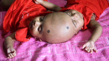Joined at the head: Surgery Hope For Conjoined Twins from Bangladesh