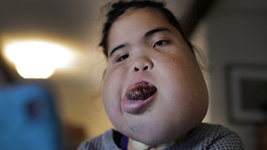 Teenager With Facial Tumour Proves Doctors Wrong