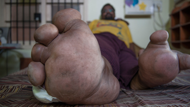My 220lbs Leg: Rare Genetic Mutation Leaves Man A Prisoner In His Own Home