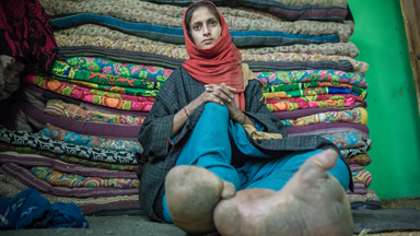 The Woman With Giant Feet