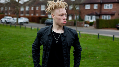 Model With Albinism Inspires Kids With Condition