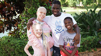My Twin Sister Has Albinism