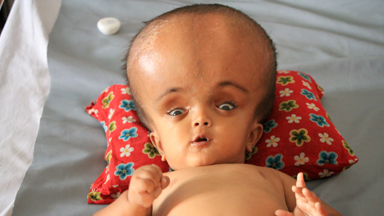 Baby With Swollen Head Hopes For Life-Saving Surgery