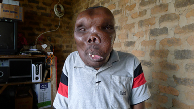 'Uganda's Most Unusual Looking Man' finally receives a diagnosis
