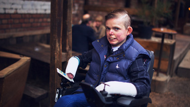 22-Year-Old With Severe Skin Condition Lives Life To The Fullest