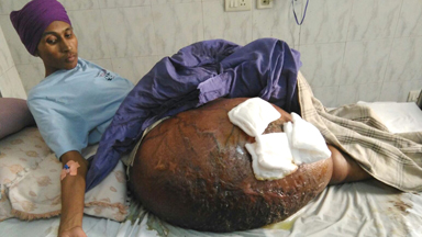 New Delhi Father Has Enormous 55kg Tumour Removed