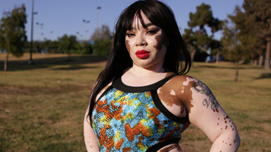 Born Different: Vitiligo Queen Beats the Bullies