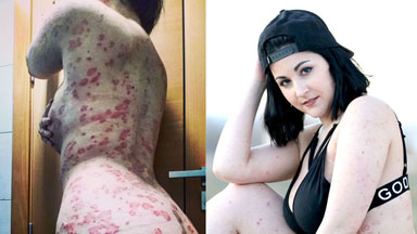 My Psoriasis Doesn't Stop Me Feeling Beautiful