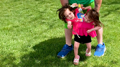 Miracle Conjoined Twins Learning To Walk
